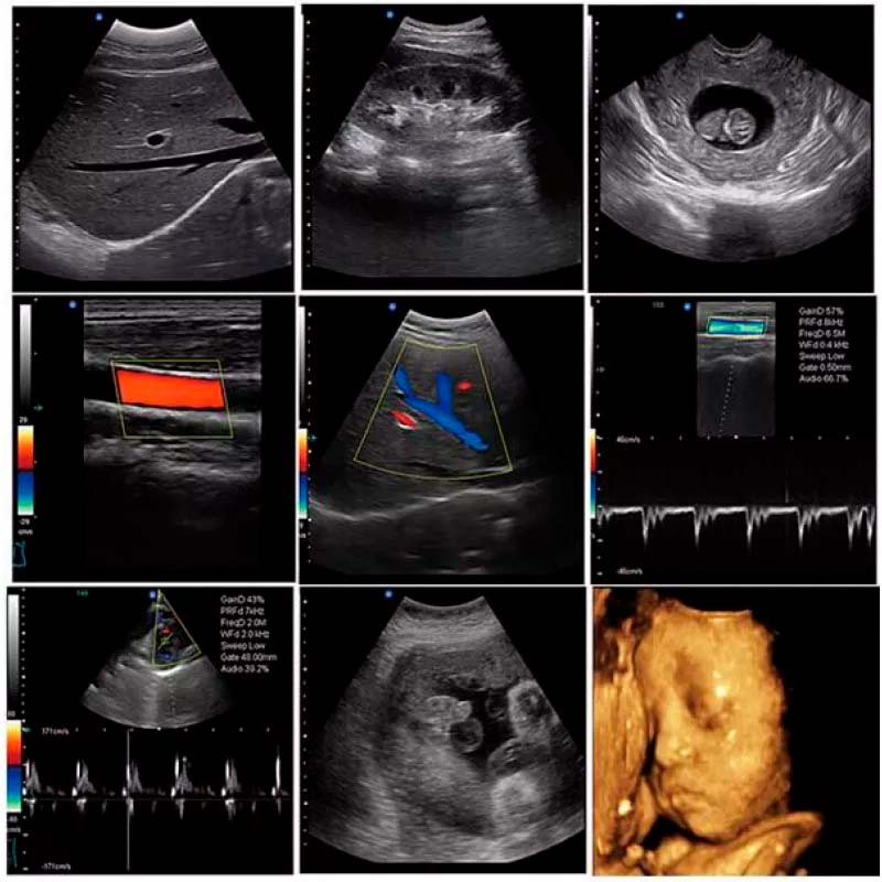 Révolutionner le Diagnostic Médical avec le Scanner À Ultrasons