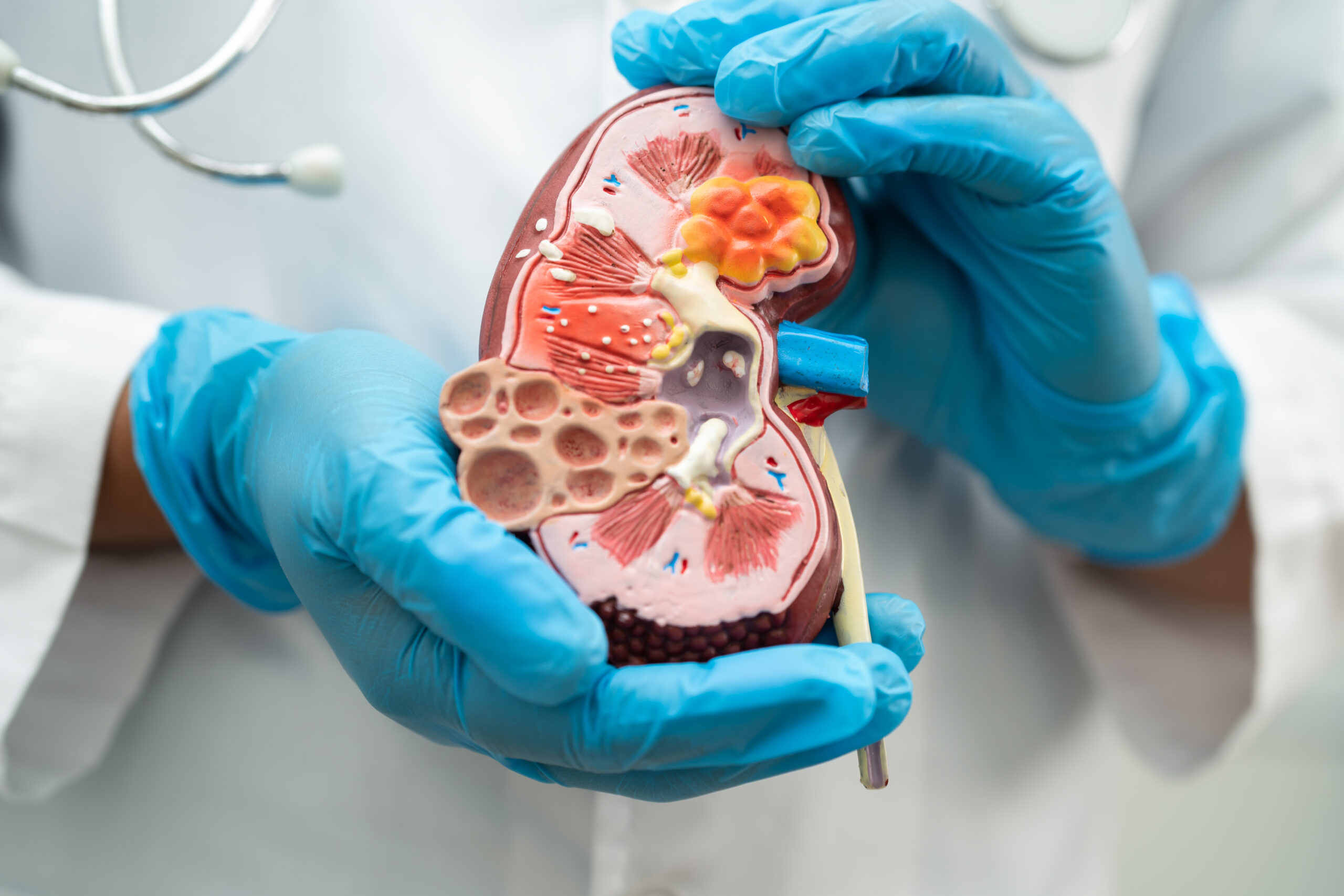 Protéinurie : un biomarqueur clé mais pas suffisant pour diagnostiquer les maladies rénales